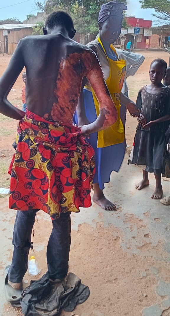 Outrage in Pallisa After Mentally Challenged Man Scalded by Unknown Assailants