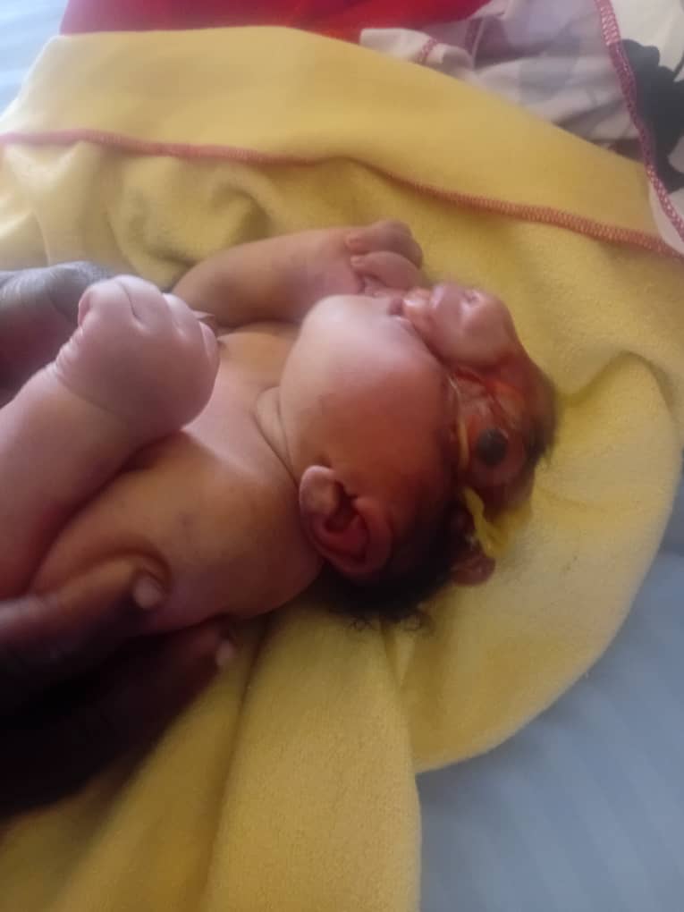 Shock as Baby Born with Rare Deformities at Pallisa General Hospital Dies